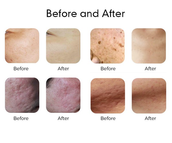 Thulium Laser Facial Before After Thulium Laser Facial Before After